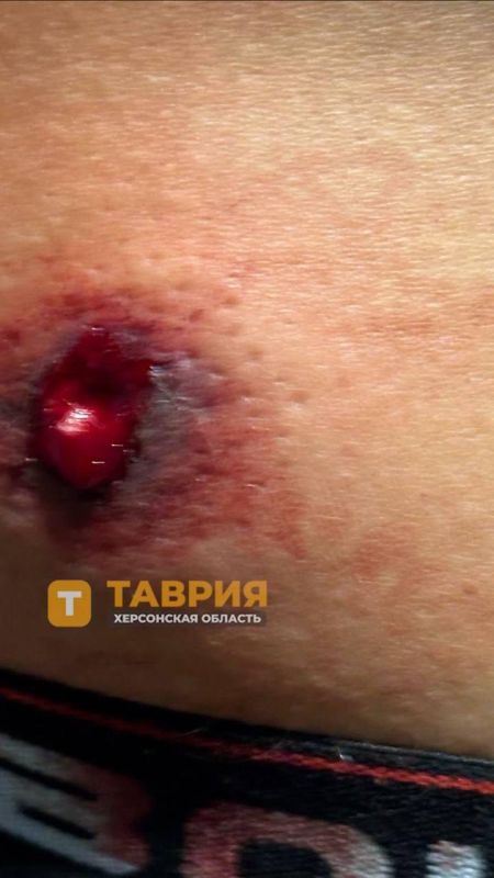 Кадры ранения жителя Сергеевки Херсонской области, в поясницу которого попал осколок, вследствие атаки дрона Кадры ранения жителя Сергеевки Херсонской области, в поясницу которого попал осколок, вследствие атаки дрона