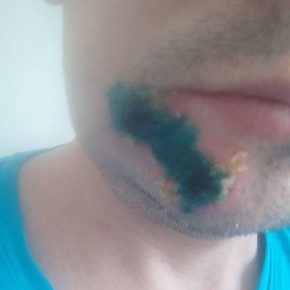 Оспа обезьян подтвердилась у одного из больных в Домодедове