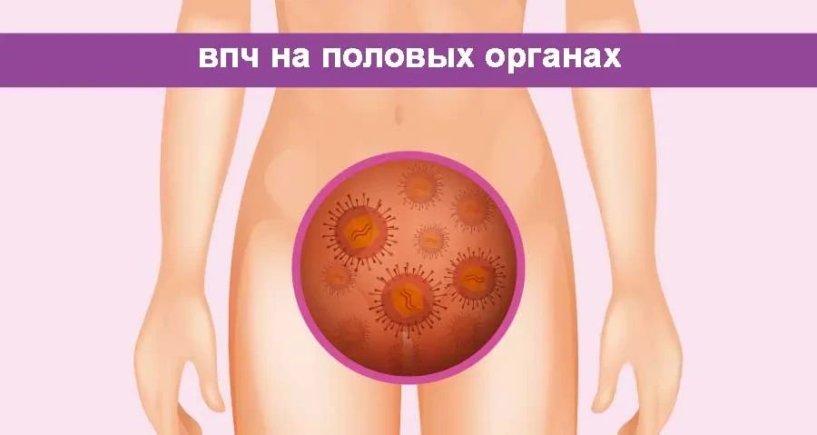 Аногенитальные (венерические) бородавки — это не только эстетическая проблема